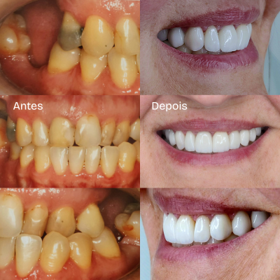 Antes e depois Karen Corazza